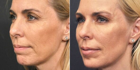 before and after plasma rejuvenation photos