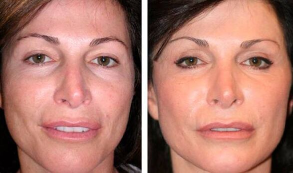 photo before plasma facial skin rejuvenation