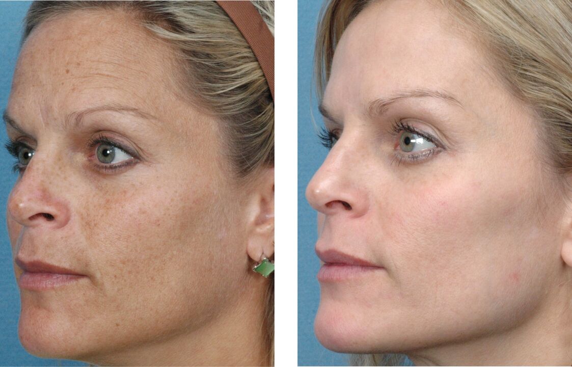 skin rejuvenation before and after photo 1