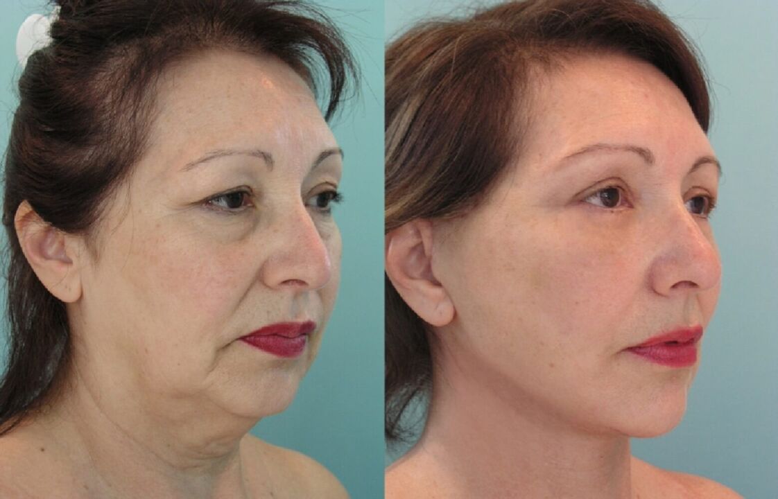 Before and after thread face lift