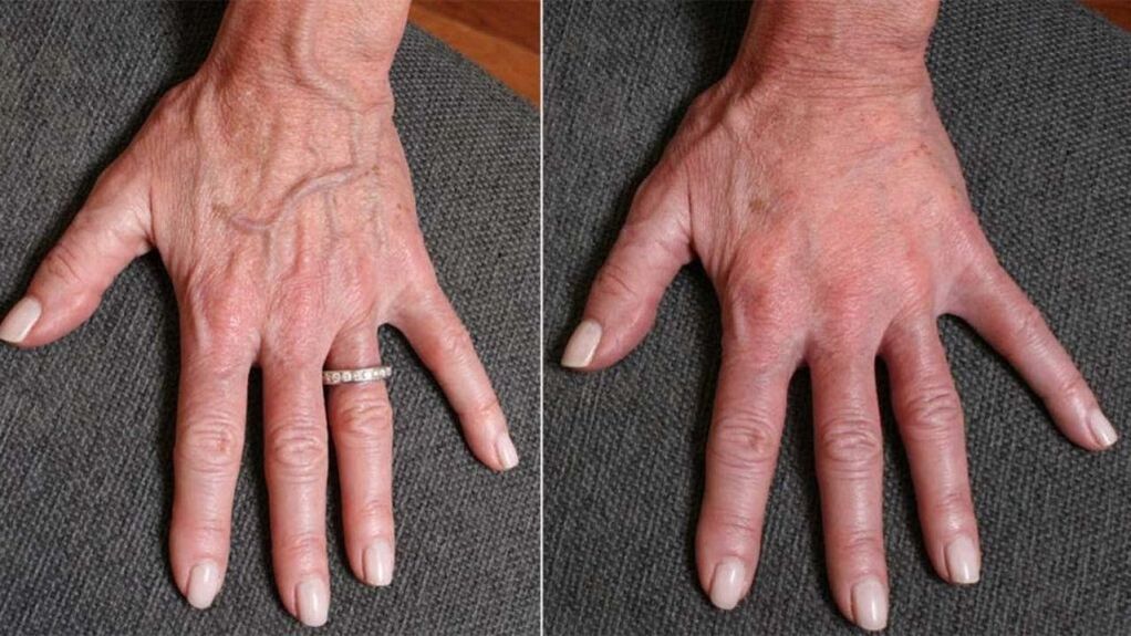 before and after contour plastic, hand rejuvenation photo 1